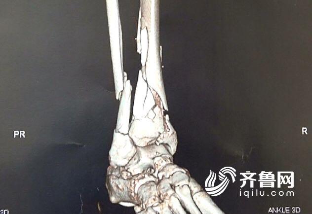 济南:男子好心捆绑垂落线缆 小腿被打到致骨折