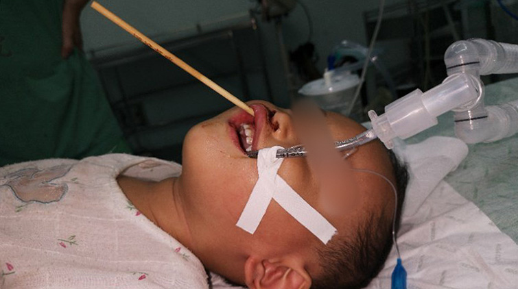 20厘米竹签从嘴里插入颅内！男童治疗后症状稳定