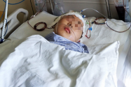 寿光13岁少年接受多次开颅手术 父母负债累累只为救儿一命