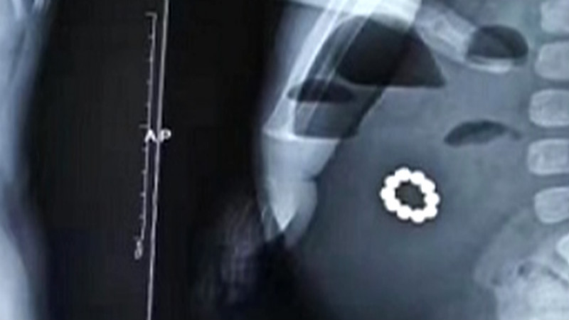 67秒丨淄博1岁8个月男孩误吞10颗磁力珠 在体内吸成一串手链