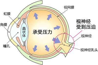 更可怕的是,得了青光眼,一旦错过治疗的时机,对眼睛所造成的损害是不
