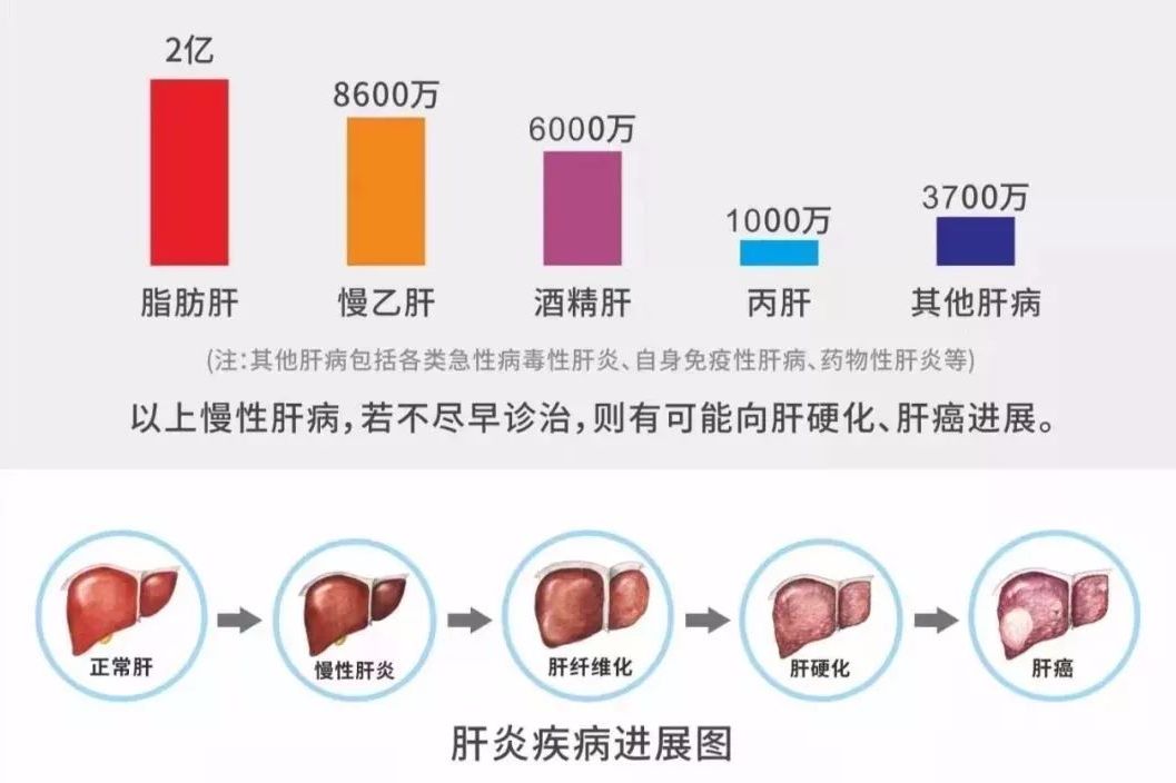 脂肪肝,乙肝,肝硬化,酒精肝等成常见肝病,越来越年轻化,发病率持续走