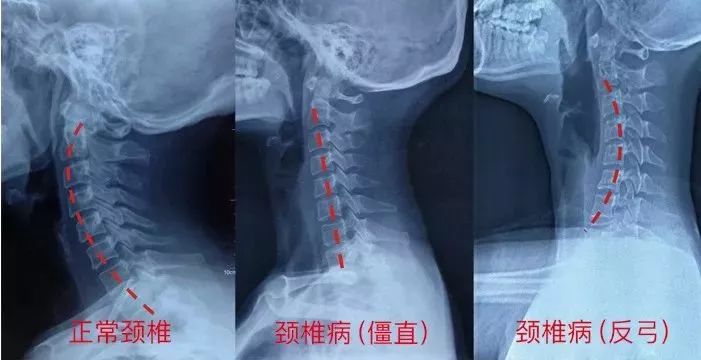 脖子僵硬腰背酸痛每天睡前用上它颈椎就舒服了