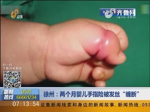 徐州：两个月婴儿手指险被发丝“缠断”