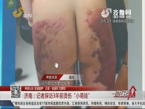 济南：记者探访3年前烫伤“小萌娃”