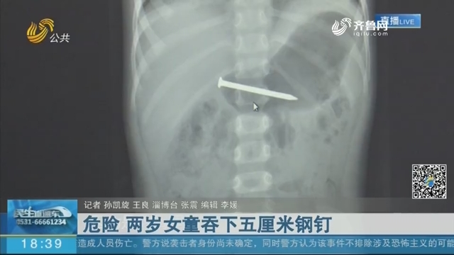 淄博：危险 两岁女童吞下五厘米钢钉