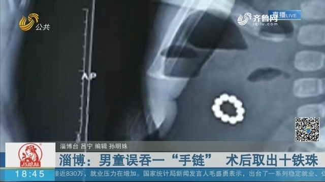 淄博：男童误吞一“手链” 术后取出十铁珠