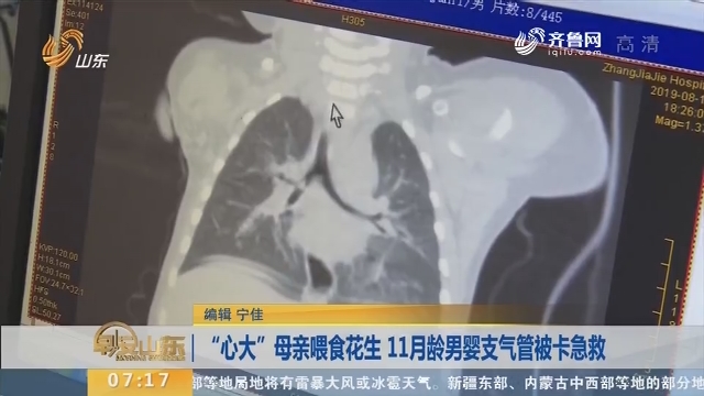 【闪电新闻排行榜】“心大”母亲喂食花生 11月龄男婴支气管被卡急救