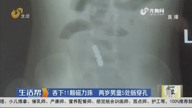 淄博：吞下11颗磁力珠 两岁男童5处肠穿孔