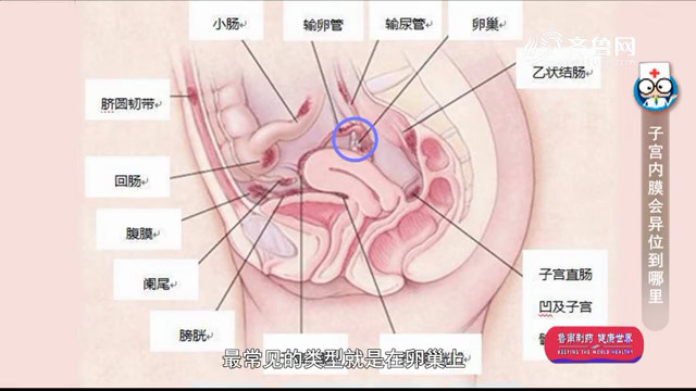 子宫内膜会异位到哪里