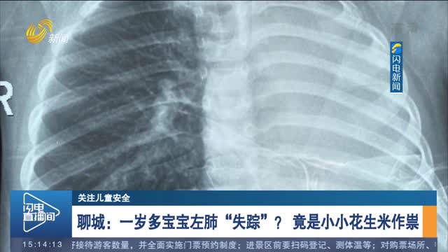 聊城：一岁多宝宝左肺“失踪”？ 竟是小小花生米作祟
