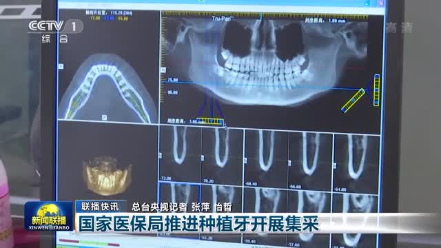 【联播快讯】国家医保局推进种植牙开展集采