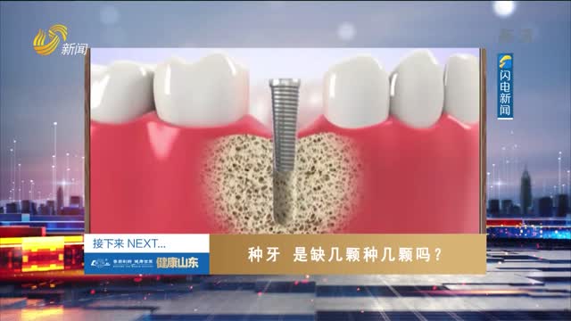 20221104《健康山东》：种牙 是缺几颗种几颗吗？