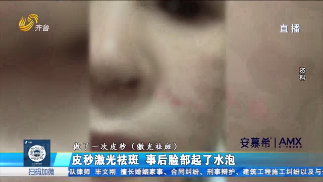 济南：脸部美容被烧伤 如何维权？