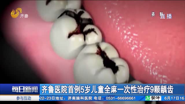 齐鲁医院首例5岁儿童全麻一次性治疗9颗龋齿