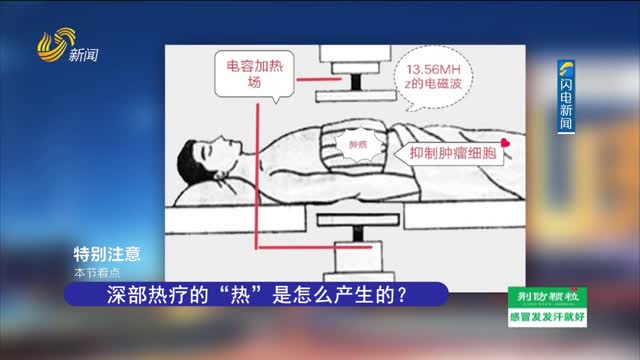 20230725《健康山東》：腫瘤治療的新方式——“熱”死腫瘤