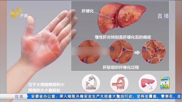 女子曬手掌被提醒肝掌查出肝硬化