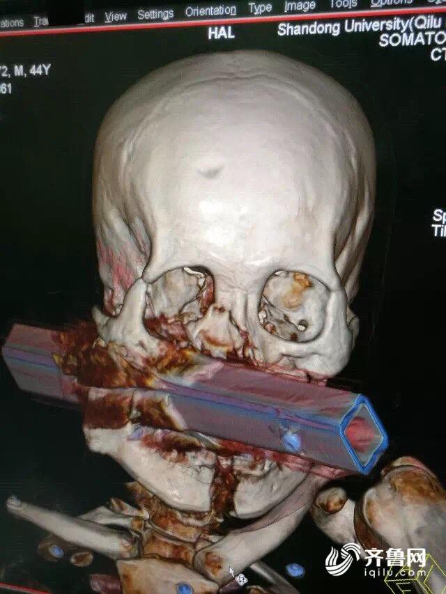 约3厘米的方形中空钢管自右侧上颌骨至同侧耳后贯穿,形成严重的贯通伤