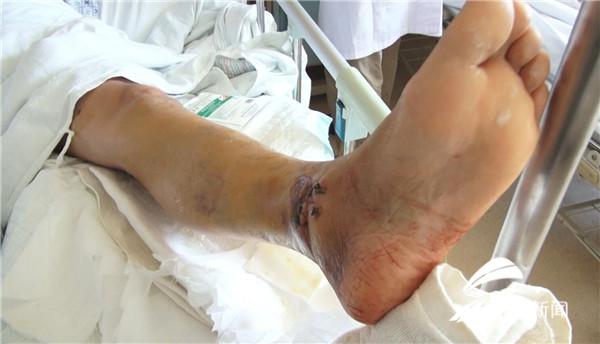 醉酒男殴打俩女子退伍军人施救被打断腿再遇这种事我还帮