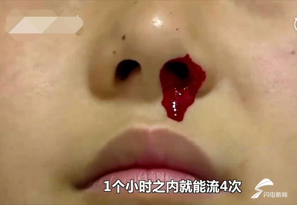 一學習運動就流鼻血濟南男孩小田為啥怪病纏身