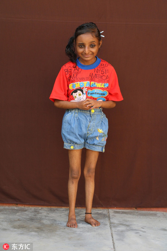 印度18岁女孩身高仅80厘米手脚尺寸像两岁小孩