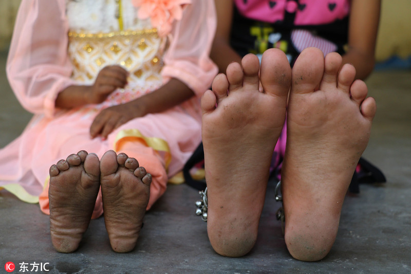 印度18岁女孩身高仅80厘米手脚尺寸像两岁小孩