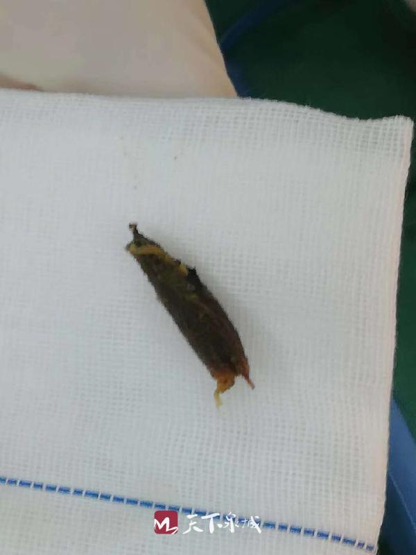 惊险这颗枣核卡在78岁老人肠腔近一个月