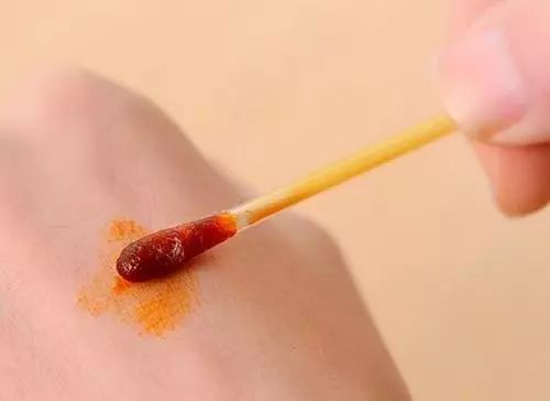 首先要及时用肥皂水清理伤口,涂抹碘酒,接下来观察有没有发热,头痛