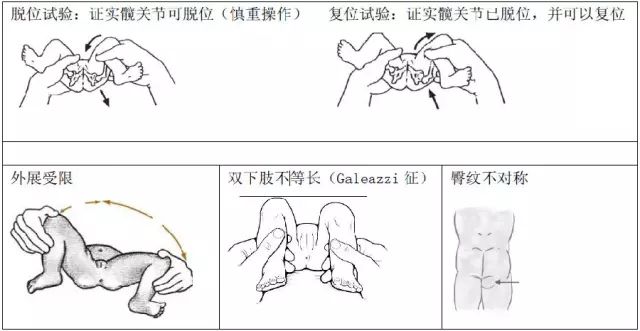 婴儿髋关节自测图图片