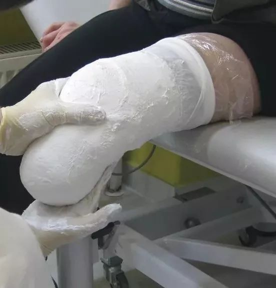 以下肢假肢为例,首先,要用石膏绷带缠在残肢末端取型