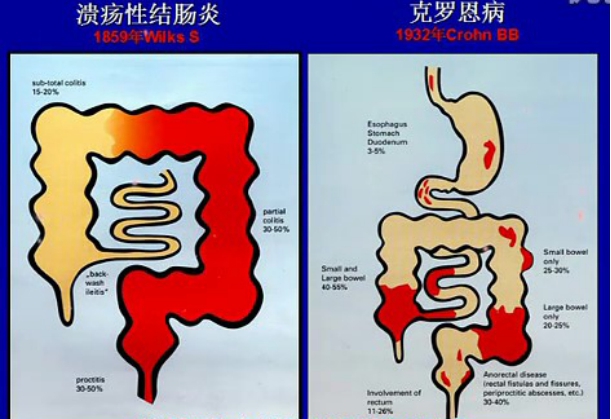 八旬老教授發現另類克羅恩病治療方法