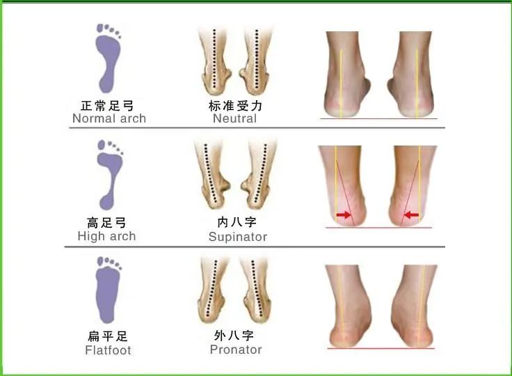 足外翻,扁平足,脚踝粗大,弹跳力差站立或步行时腿型成x型,裤子膝盖