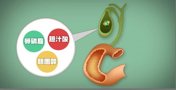 膽汁酸鹽等濃度過高或過飽和,膽汁儲存在膽囊內就容易沉積並結晶析出