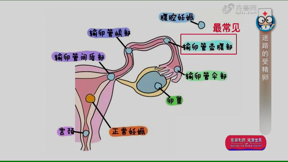 宫外孕是怎么回事?