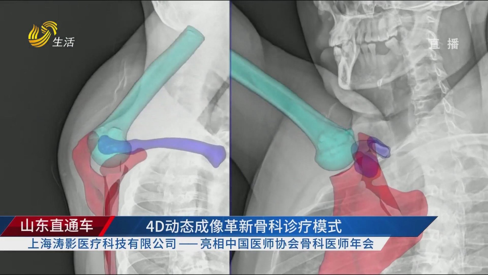 山东直通车：硬核装备 革新骨科诊疗模式——上海涛影医疗科技有限公司